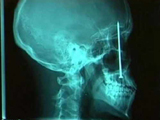 You wont believe what the surgeons discover on some x-rays